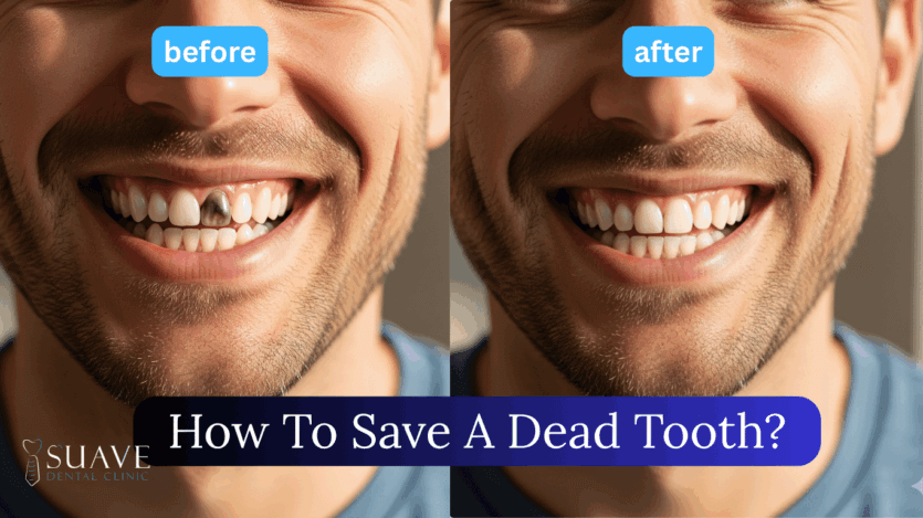 how to save a dead tooth at Suave Clinic
