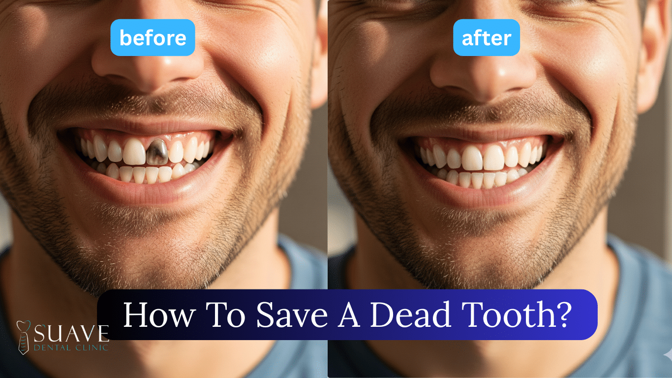 how to save a dead tooth at Suave Clinic