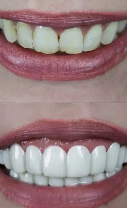 snap-on veneers goes wrong