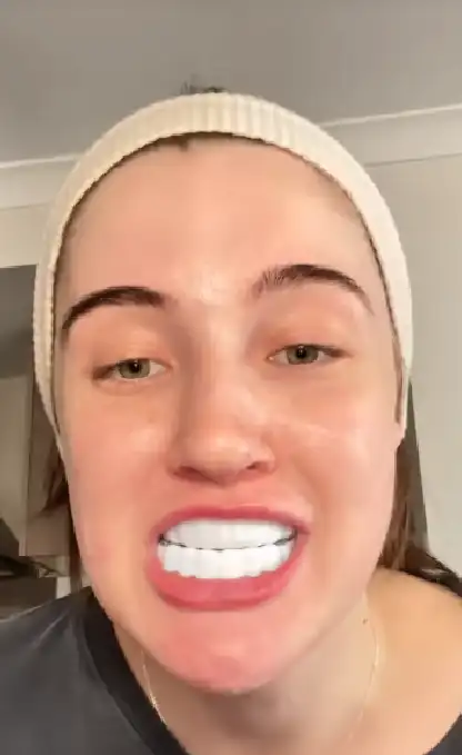 removable diy online veneers failure results