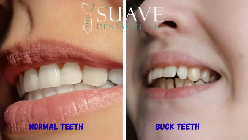 buck teeth versus normal perfect teeth
