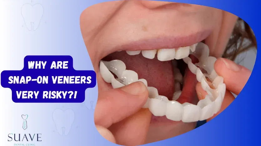 snap-on veneers, removable DIY veneers risks
