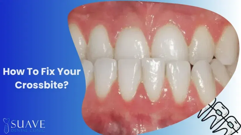 how to fix crossbite with Suave Clinic