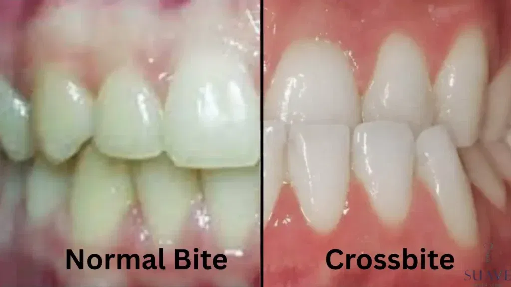 crossbite vs. normal bite, crossbite teeth correction