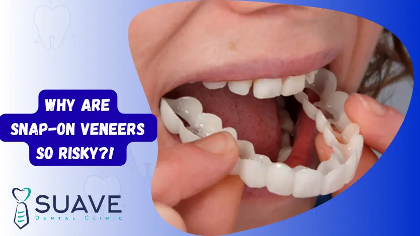 Snap-on veneers are so risky see the alternatives with Suave Clinic