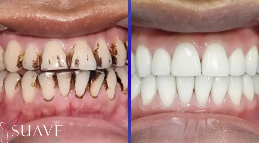 teeth discolorations and stains treatment with Suave Clinic