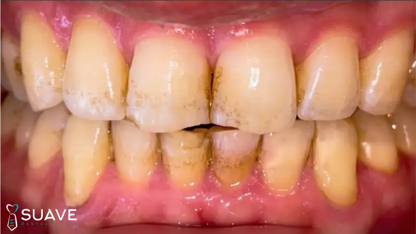 Tooth Cavity vs. Stain 6 cavity vs stains, with suave clinic