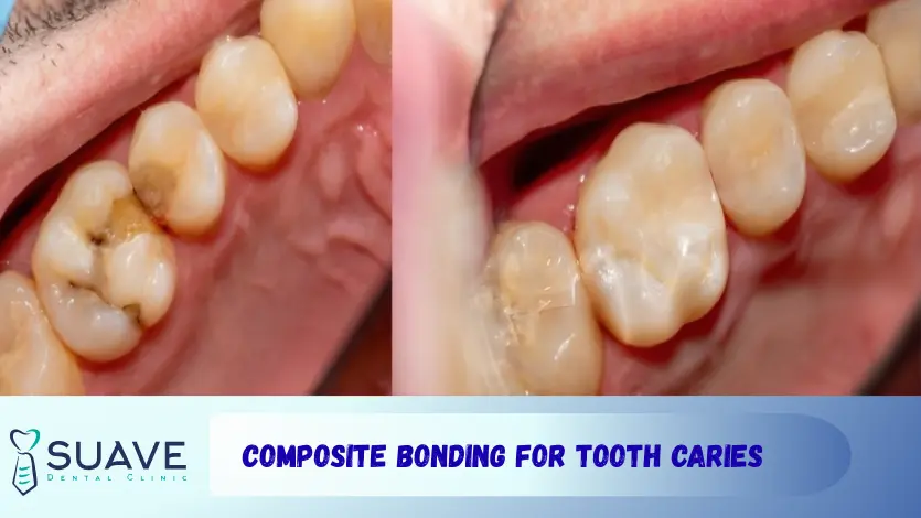 composite bonding restoration for filling tooth caries