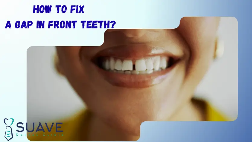 different dental treatments to fix a gap in front teeth