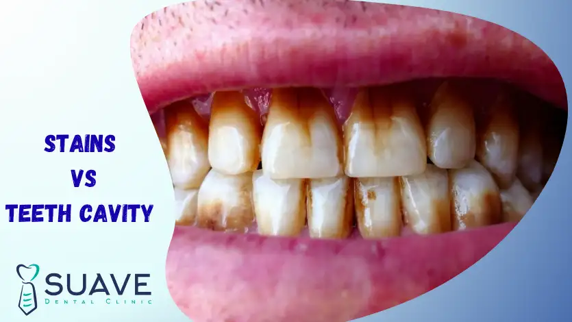 Tooth Cavity vs. Stain 5 the difference of teeth stains vs cavity
