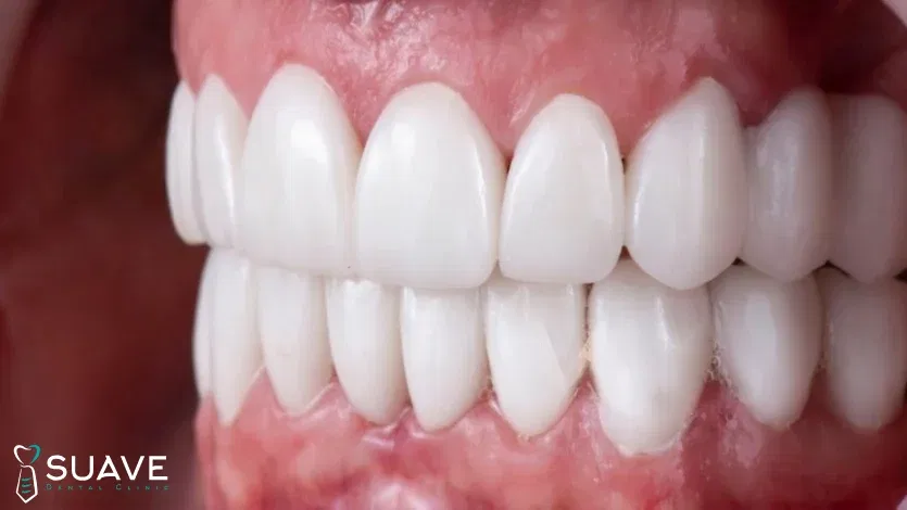 Turkey Teeth 5 turkey teeth in Turkey in Suave Clinic