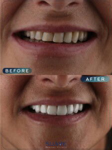Dental Veneer Smile