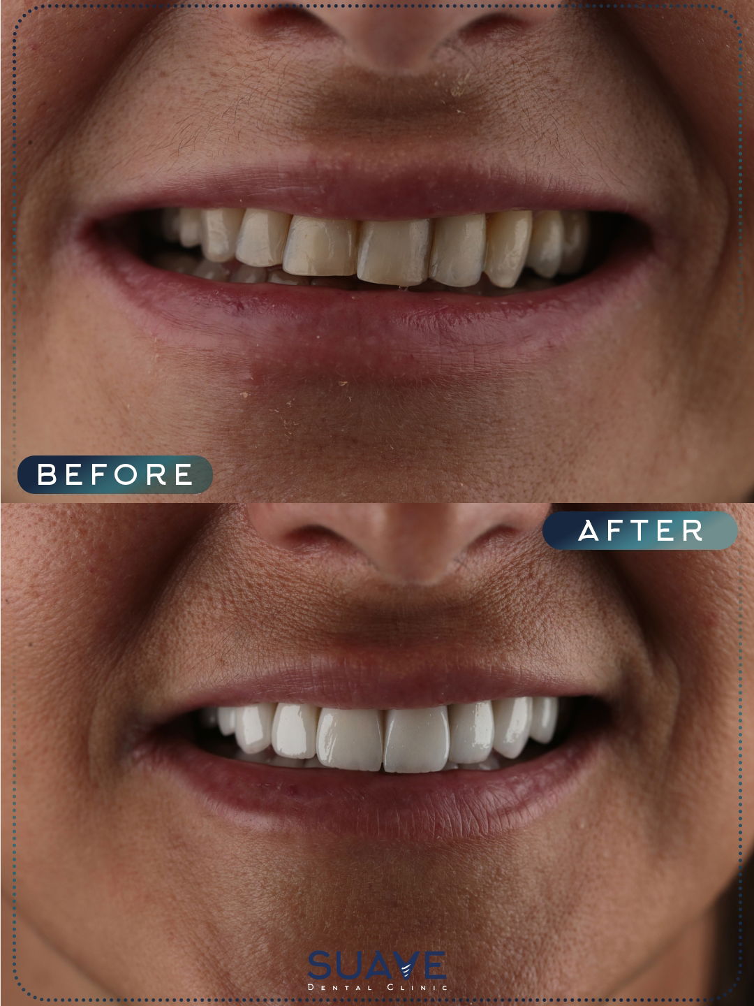 Dental Veneer Smile