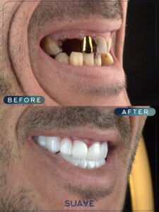 Full mouth implant