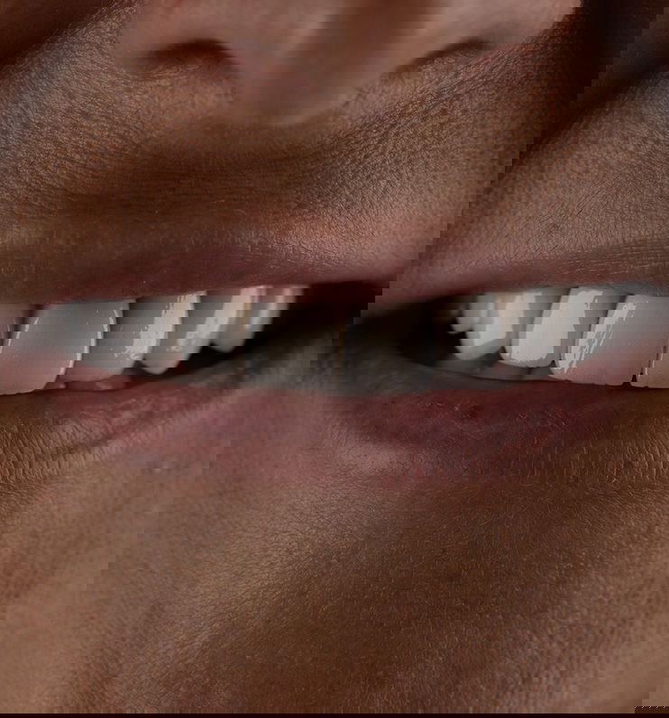 Dental Veneers in Turkey 5 Veneers hero 2