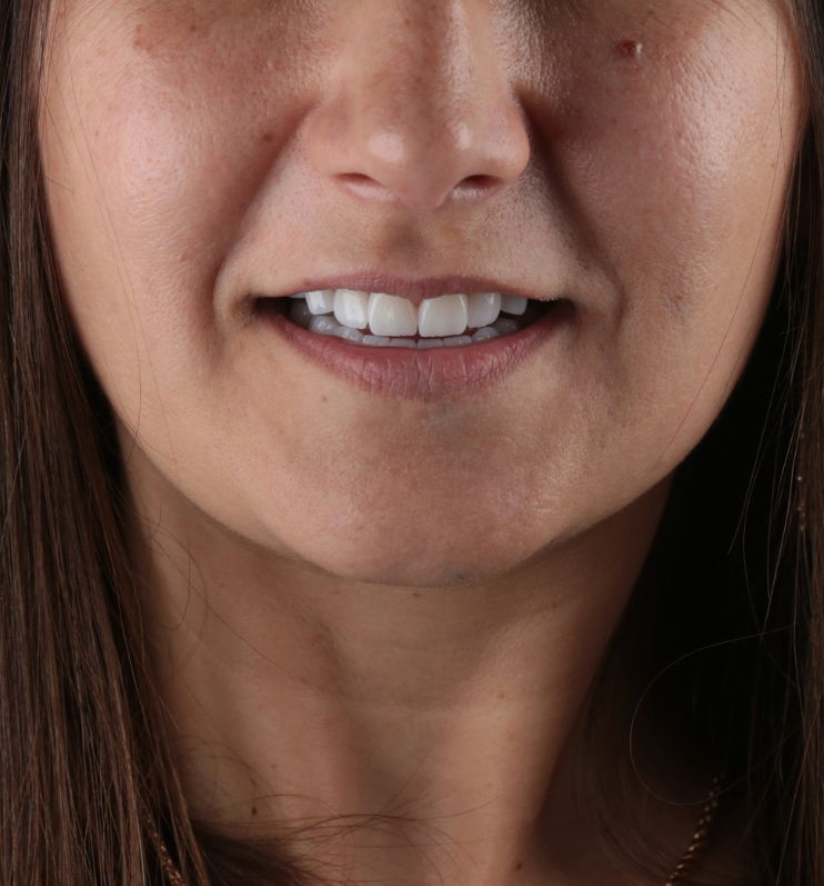 Invisalign in Turkey 6 Veneers smile2