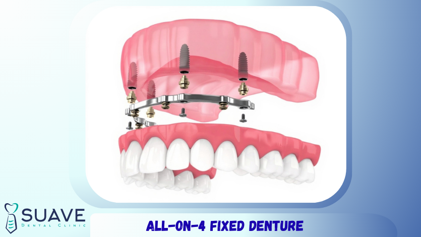 All-on-4 or All-on-6? 7 all-on-4 dental implant restoration for full mouth implants