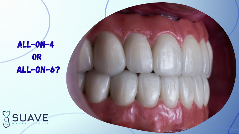 All-on-4 or All-on-6? 5 All-on-4 or All-on-6 dental implants with Suave Clinic