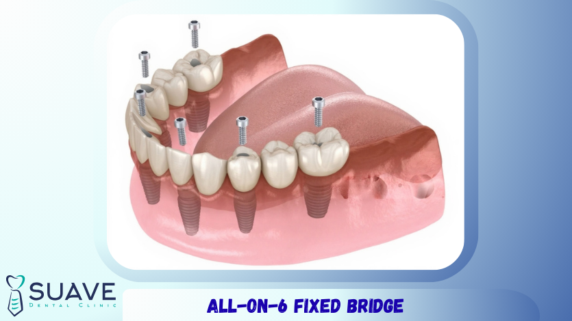All-on-4 or All-on-6? 8 all-on-6 dental implants for full moth fixed bridges
