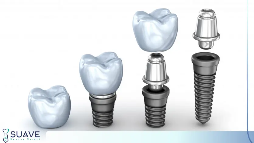 An Implant or A Crown? 5 how to restore your teeth; an implant or a crown of a dental bridge