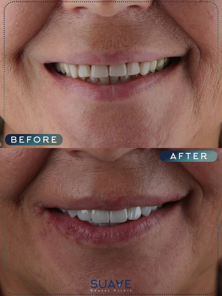 dental crowns or veneer