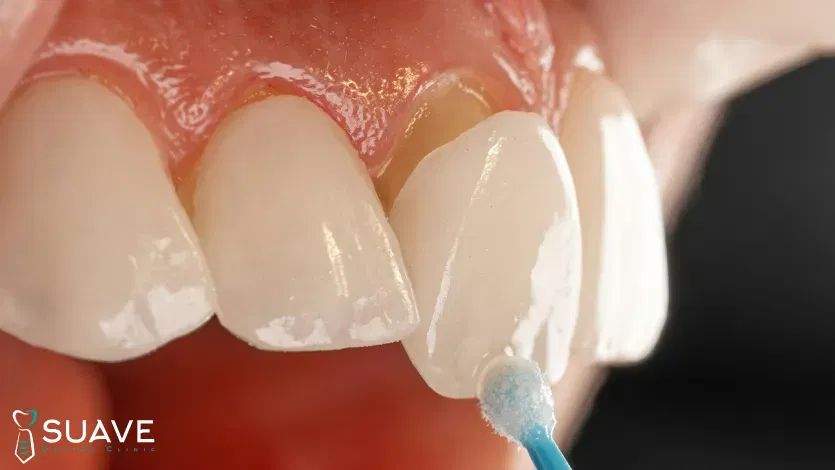 Full Mouth Veneers 10 full mouth veneers for hollywood smile