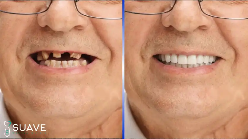 Full Mouth Reconstruction 5 full mouth reconstruction with suave clinic