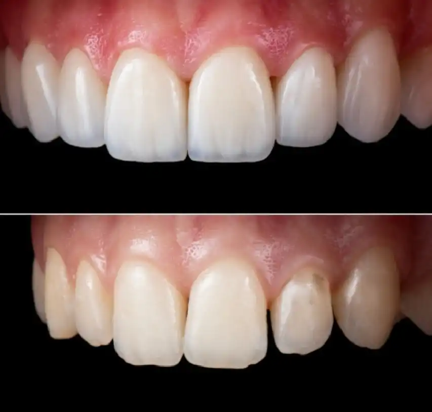 Full Mouth Veneers 14 full mouth veneers packages to fix teeth