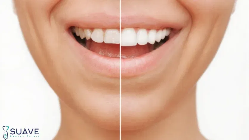 Full Mouth Veneers 5 full mouth veneers before and after with suave clinic