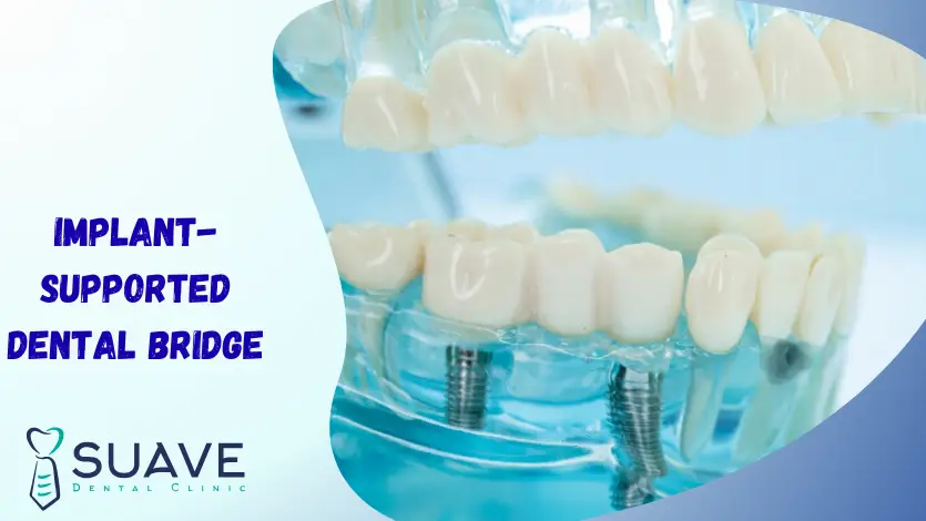 implant-supported bridge, replace missing teeth with implants