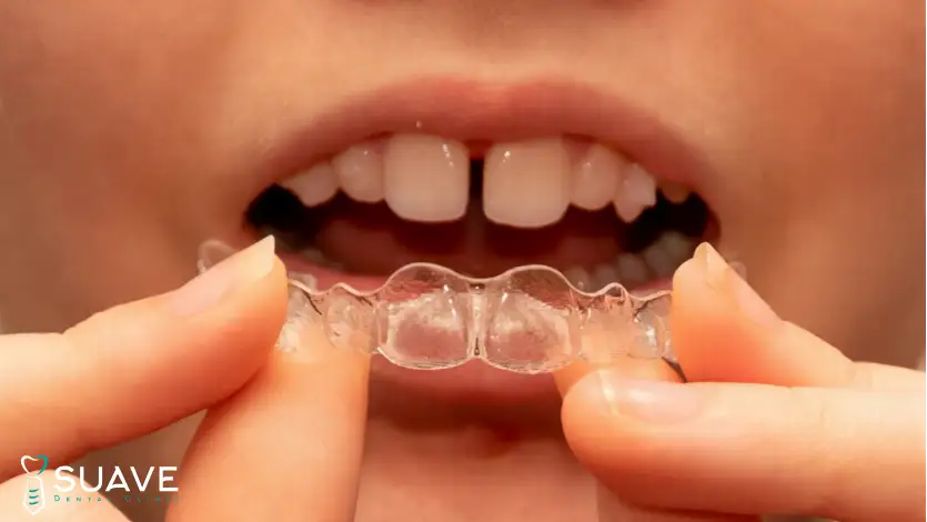 Invisalign for teeth gaps - Suave clinic