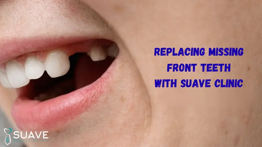 Replacing Missing Front Teeth 5 replacing missing front teeth with suave clinic