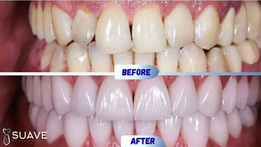 zirconia veneers before and after at Suave Clinic