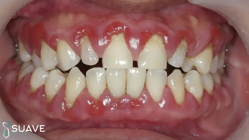 cosmetic gum surgery for esthetics gingival treatment 