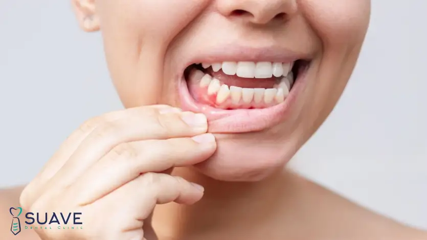 cosmetic gum surgery with Suave Clinic