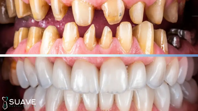 full-mouth reconstruction with full mouth crowns