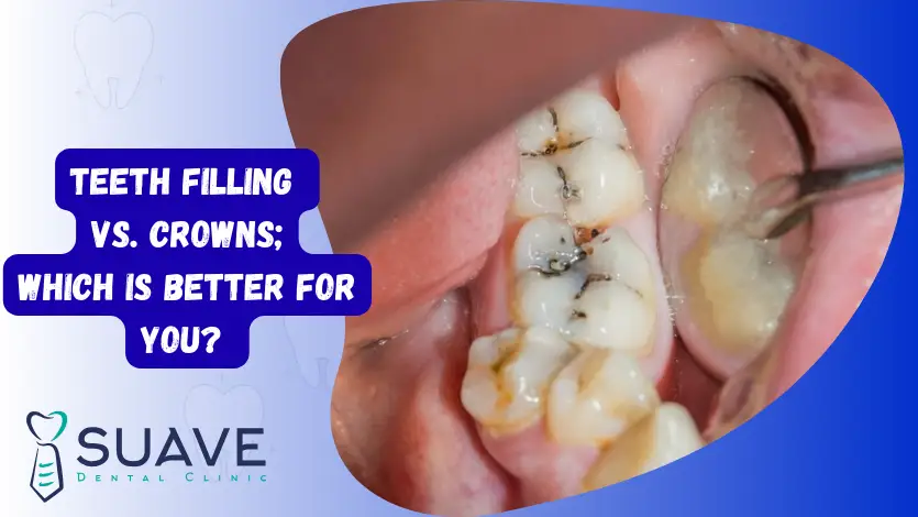 tooth filling vs crowns, teeth filling versus crowns restoration