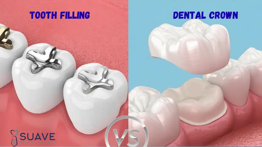 Home 5 tooth filling vs crowns; which is better for you?