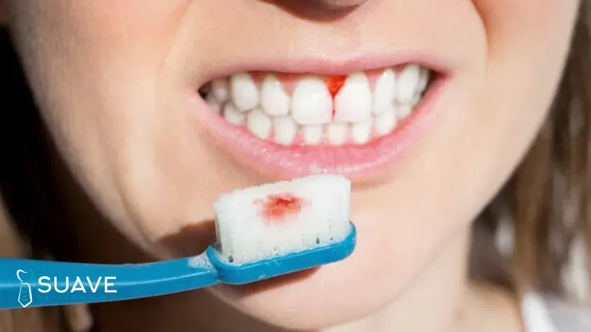 My Gums Bleed When I Brush My Teeth 6 Gums bleeding on brushing fixed with Suave clinic