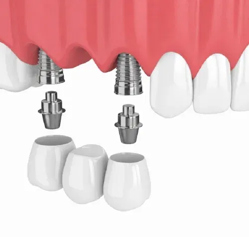 implant-supported bridge to restore two or more missing teeth