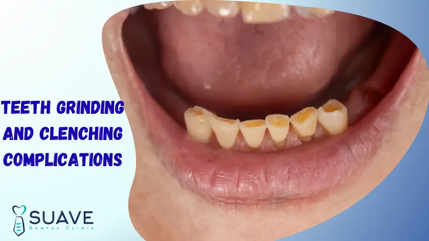 Why Do I Grind My Teeth at Night? 6 teeth grinding and clenching, bruxism