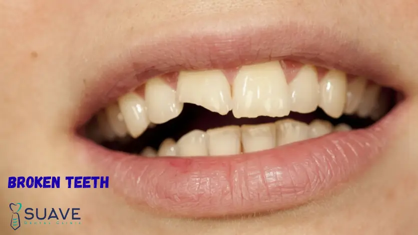 Home 5 broken teeth restorations and treatment of tooth fracture