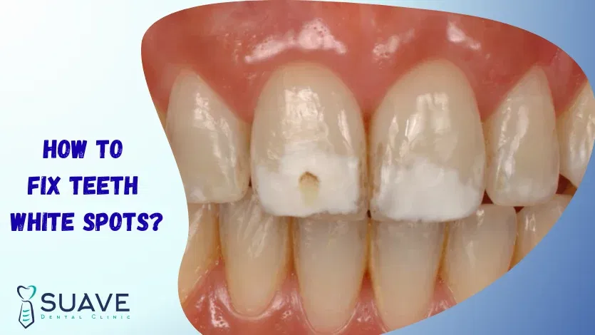 how to fix chalky white spots on teeth