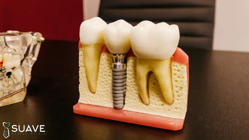 titanium dental implant for teeth replacement with Suave Clinic