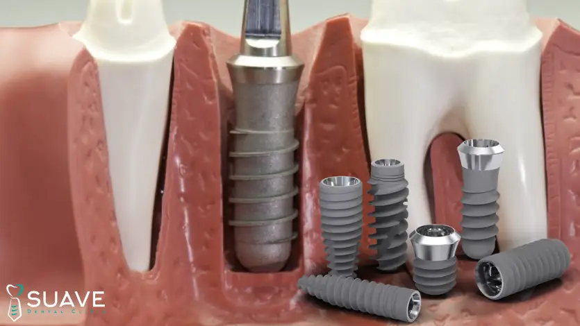 titanium dental implants for replacing missing teeth with Suave Clinic
