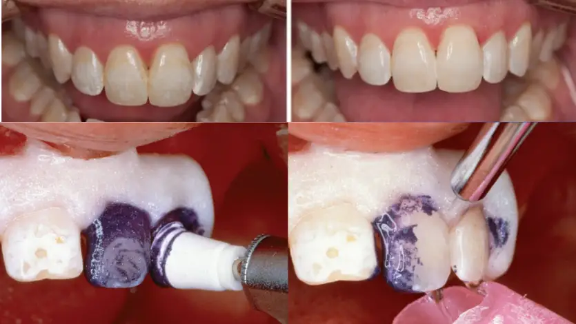 before and after teeth microabrasion, in step by step