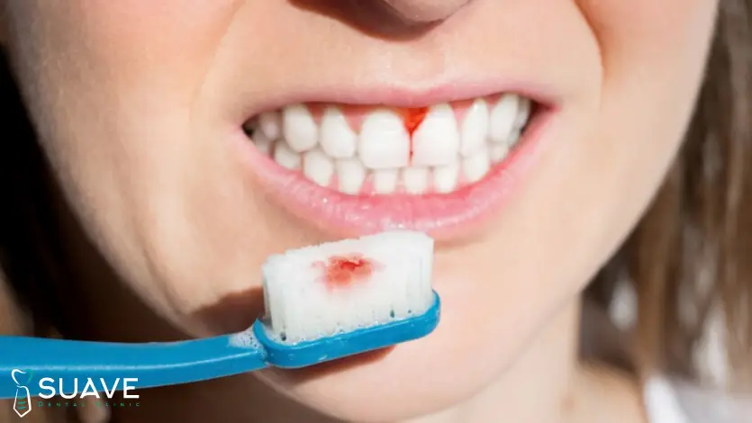 Home 5 gum pockets treatment and healing - suave clinic