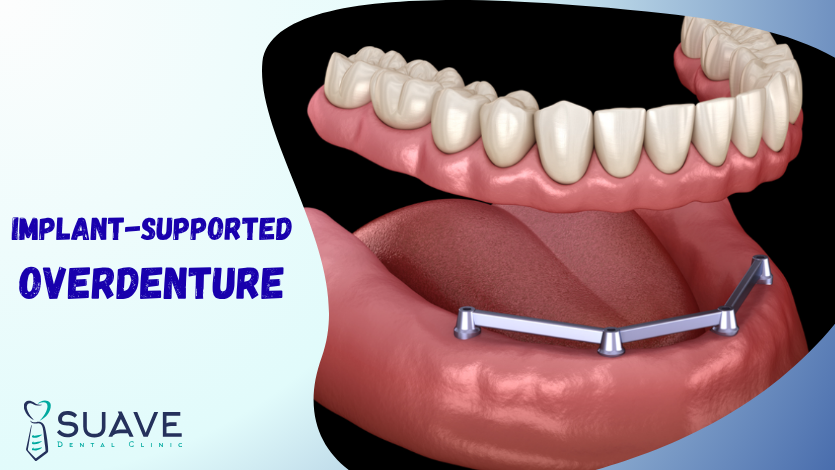 teeth/ implants-supported overdentures for multiple teeth replacement