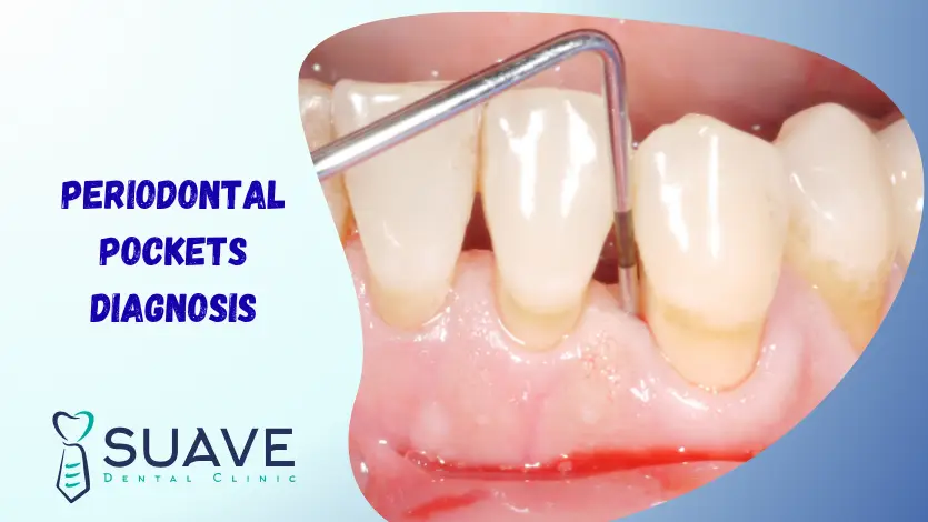 Gum pockets 8 periodontal pockets following gum recession