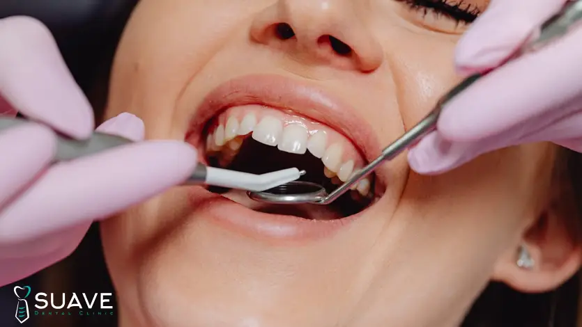 teeth microabrasion to get rid of enamel stains